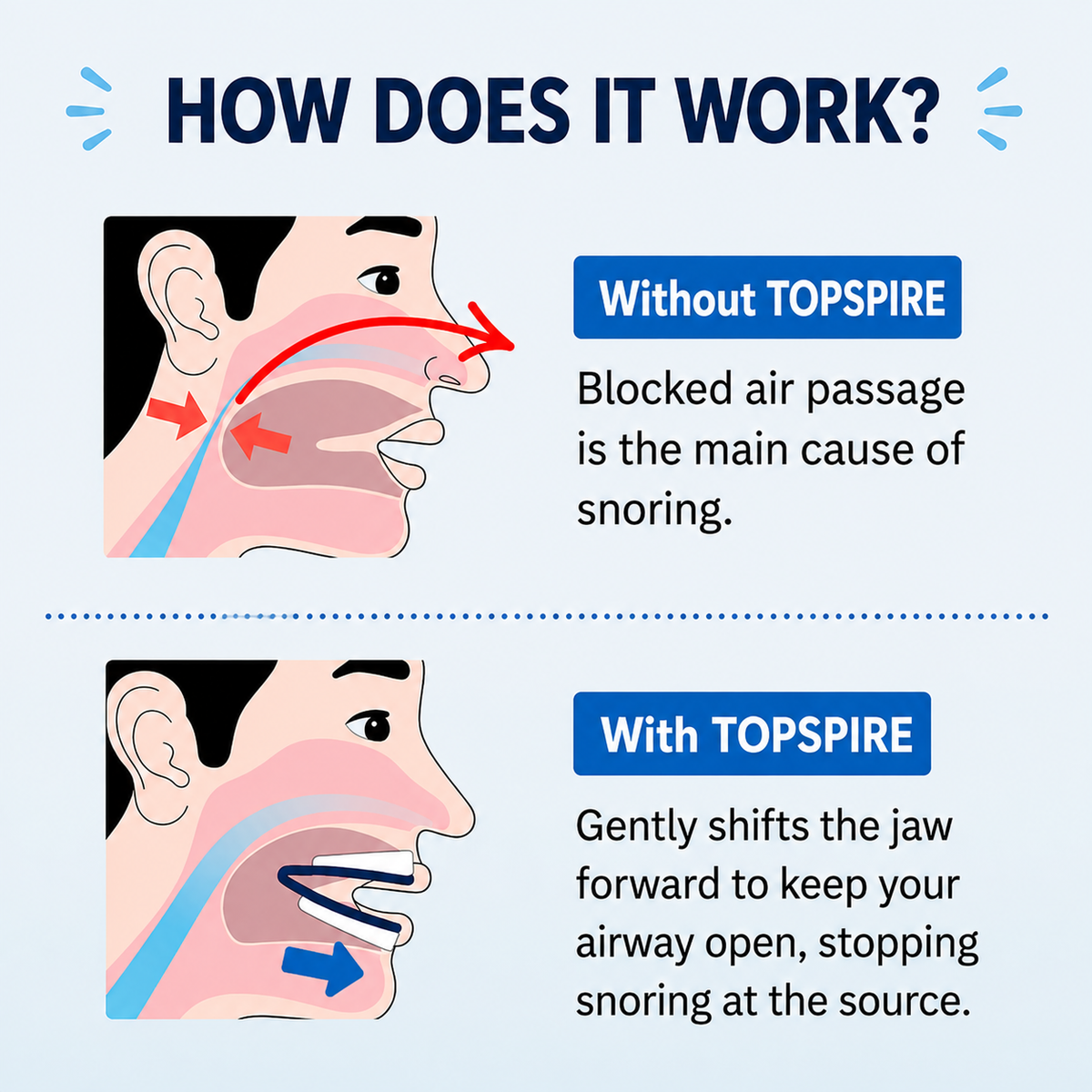 TopSpire Anti-Snoring Mouthpiece