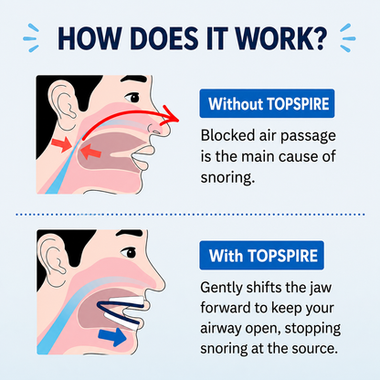 TopSpire Anti-Snoring Mouthpiece