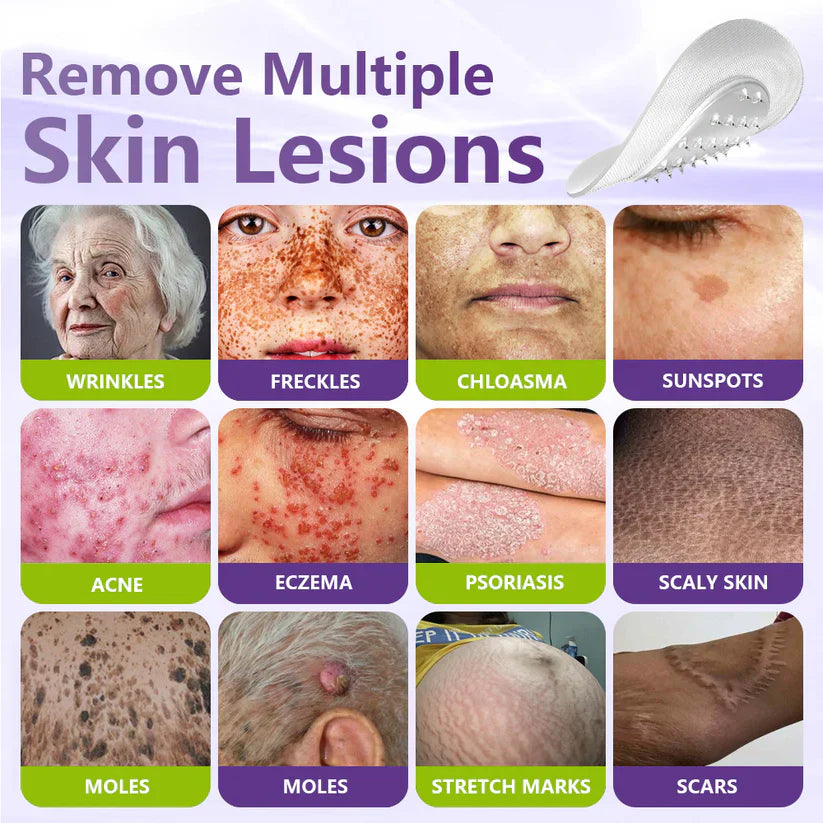 Soluble Microneedle Botanical Skin Tag Removal Patch