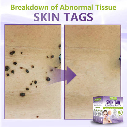 Soluble Microneedle Botanical Skin Tag Removal Patch